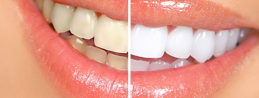 Diş Beyazlatma - Dt. Hejan Kılıç