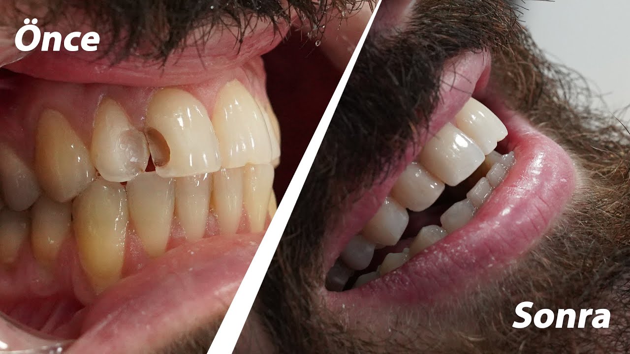 Estetik Diş Dolgusu - Dt. Hejan Kılıç