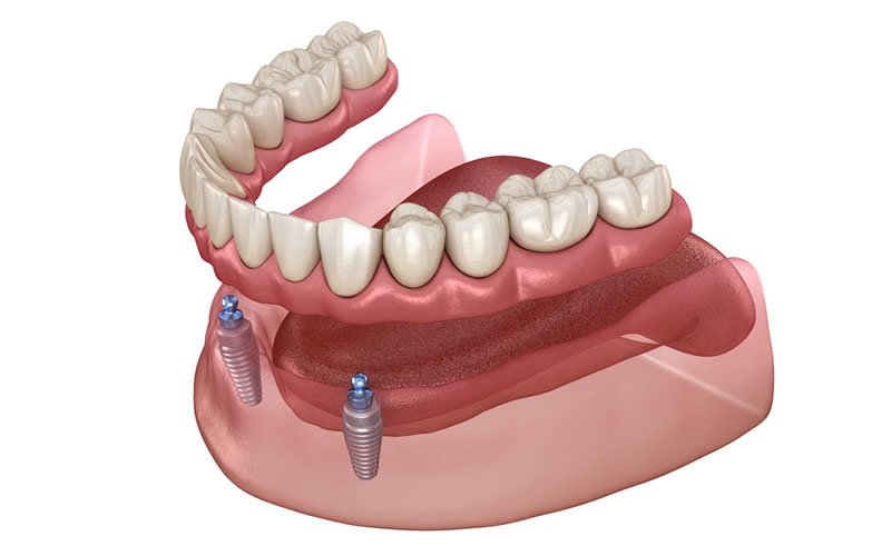 İmplant Üstü Hareketli Protezler - Dt. Hejan Kılıç