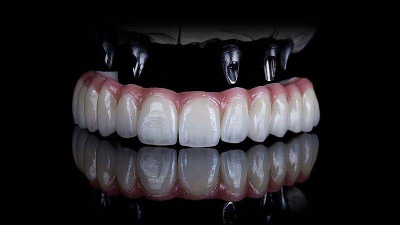 İmplant Üstü Sabit Protezler - Dt. Hejan Kılıç