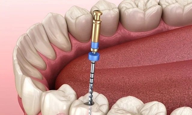 Kanal Tedavisi - Dt. Hejan Kılıç