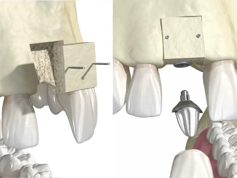 Bone Block Grafting in Istanbul | Price, Process & Results | Dr. Hejan ...
